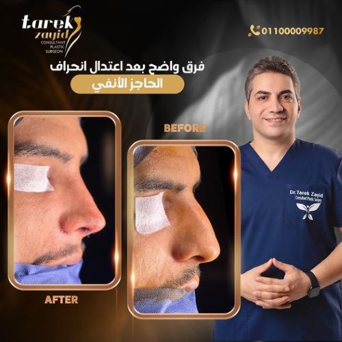 افضل دكتور تجميل انف في مصر 2026